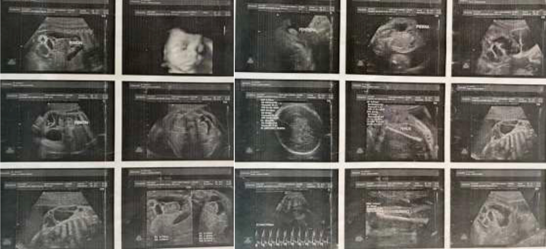 Hallazgos prenatales